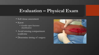 Evaluation – Physical Exam
• Soft tissue assessment
• Know
• Gustilo open fractures
classification
• Avoid missing compartment
syndrome
• Determine timing of surgery
 