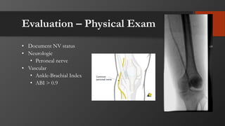 Evaluation – Physical Exam
• Document NV status
• Neurologic
• Peroneal nerve
• Vascular
• Ankle-Brachial Index
• ABI > 0.9
 