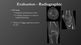 Evaluation - Radiographic
• CT scan
• Surgical consideration exists
• Complex fractures to assist in
surgical planning
• Obtain CT after applying traction
(ex fix)
 