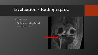 Evaluation - Radiographic
• MRI scan?
• Subtle nondisplaced
fracture line
 