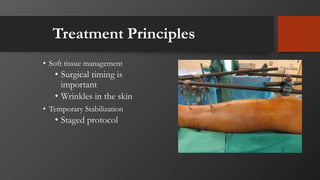 Treatment Principles
• Soft tissue management
• Surgical timing is
important
• Wrinkles in the skin
• Temporary Stabilization
• Staged protocol
 