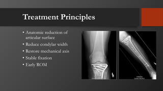 Treatment Principles
• Anatomic reduction of
articular surface
• Reduce condylar width
• Restore mechanical axis
• Stable fixation
• Early ROM
 