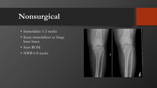 Nonsurgical
• Immobilize 1-2 weeks
• Knee immobilizer or hinge
knee brace
• Start ROM
• NWB 6-8 weeks
 