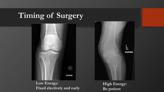 Timing of Surgery
Low Energy:
Fixed electively and early
High Energy:
Be patient
 