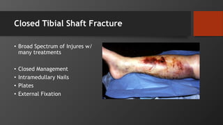 Closed Tibial Shaft Fracture
• Broad Spectrum of Injures w/
many treatments
• Closed Management
• Intramedullary Nails
• Plates
• External Fixation
 