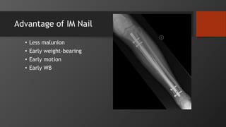 Advantage of IM Nail
• Less malunion
• Early weight-bearing
• Early motion
• Early WB
 