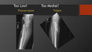Too Low! Too Medial!
Procurvatum Valgus
 