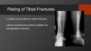 Plating of Tibial Fractures
• A plate can be used for shaft fractures
• Newer periarticular plates available for
metaphyseal fractures
 