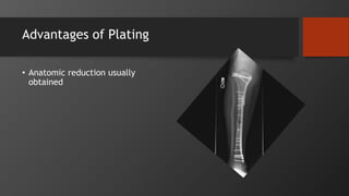 Advantages of Plating
• Anatomic reduction usually
obtained
 