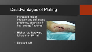 Disadvantages of Plating
• Increased risk of
infection and soft tissue
problems, especially in
high energy fractures
• Higher rate hardware
failure than IM nail
• Delayed WB
 