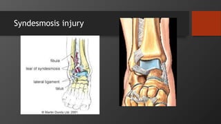 Syndesmosis injury
 