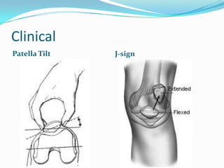 Terminal J Sign Patello femoral instability | PPTX