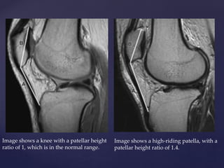 Patello femoral jt. | PPTX