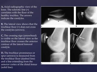 Trochlear Latera Radiograph Patello femoral joint - MRI | PPTX