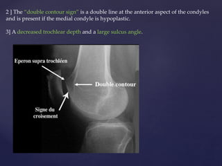 Double Contour Radiology Patello femoral joint - MRI | PPTX