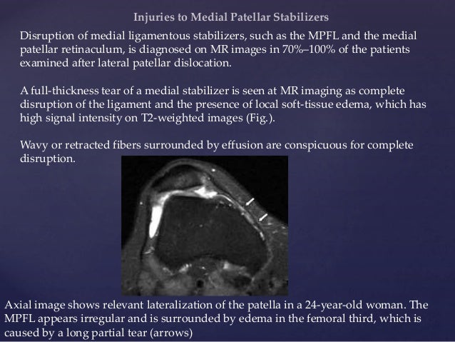 Patello femoral joint - MRI