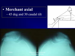 • Merchant axial
– 45 deg and 30 caudal tilt
11/3/2014 15Professor Freih Abuhassan-
University of Jordan
 
