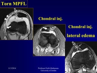 Torn MPFL
Chondral inj.
lateral edema
Chondral inj.
11/3/2014 21Professor Freih Abuhassan-
University of Jordan
 