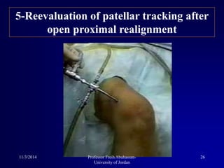 5-Reevaluation of patellar tracking after
open proximal realignment
11/3/2014 26Professor Freih Abuhassan-
University of Jordan
 