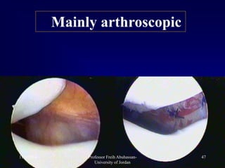 Mainly arthroscopic
11/3/2014 47Professor Freih Abuhassan-
University of Jordan
 