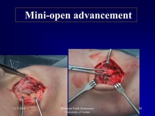 Mini-open advancement
11/3/2014 48Professor Freih Abuhassan-
University of Jordan
 