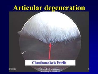 Articular degeneration
11/3/2014 51Professor Freih Abuhassan-
University of Jordan
 