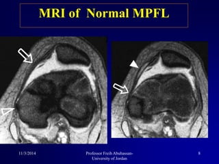 MRI of Normal MPFL
11/3/2014 8Professor Freih Abuhassan-
University of Jordan
 