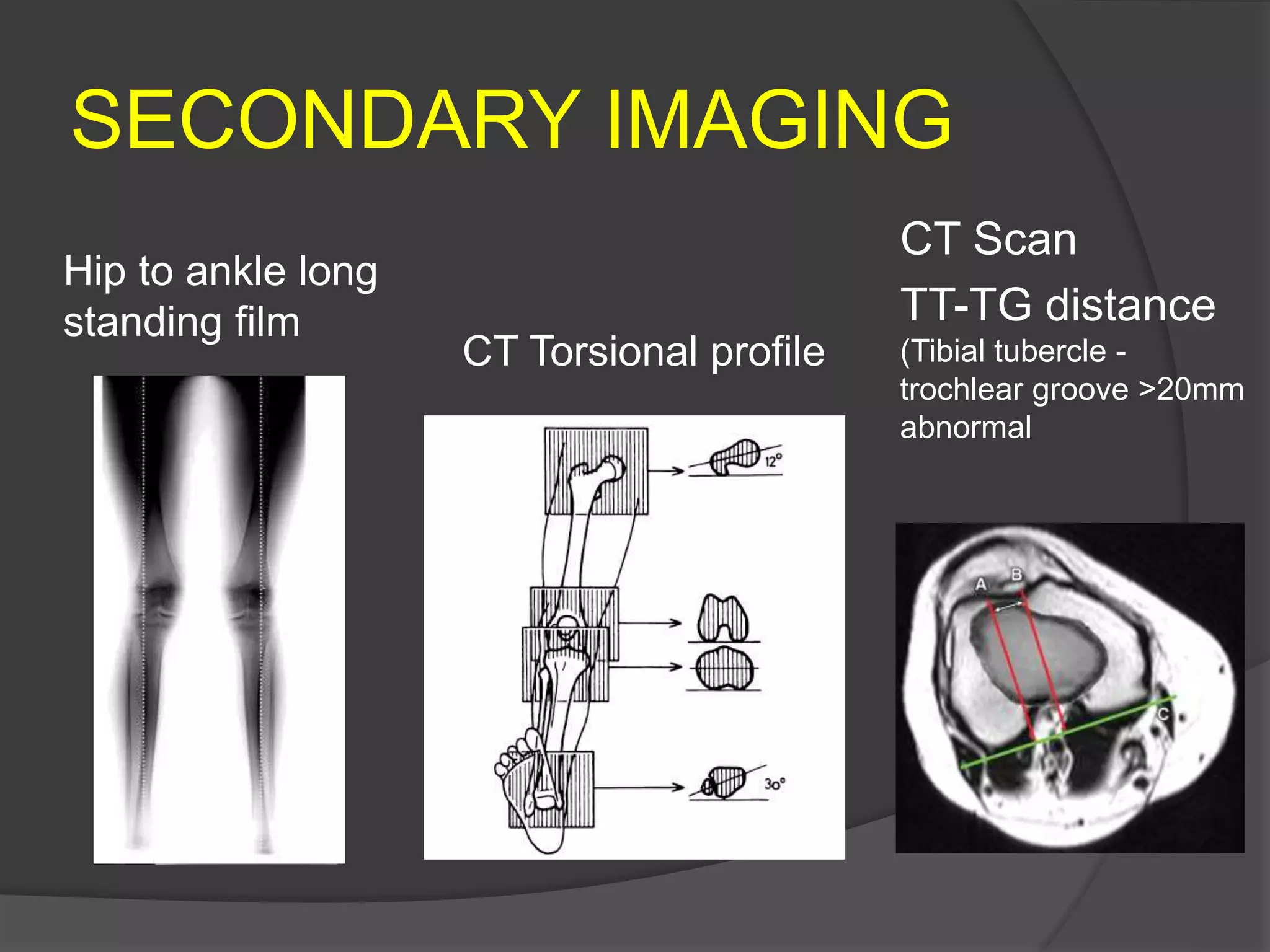 SECONDARY IMAGING
CT Scan
TT-TG distance
(Tibial tubercle -
trochlear groove >20mm
abnormal
Hip to ankle long
standing film
CT Torsional profile
 