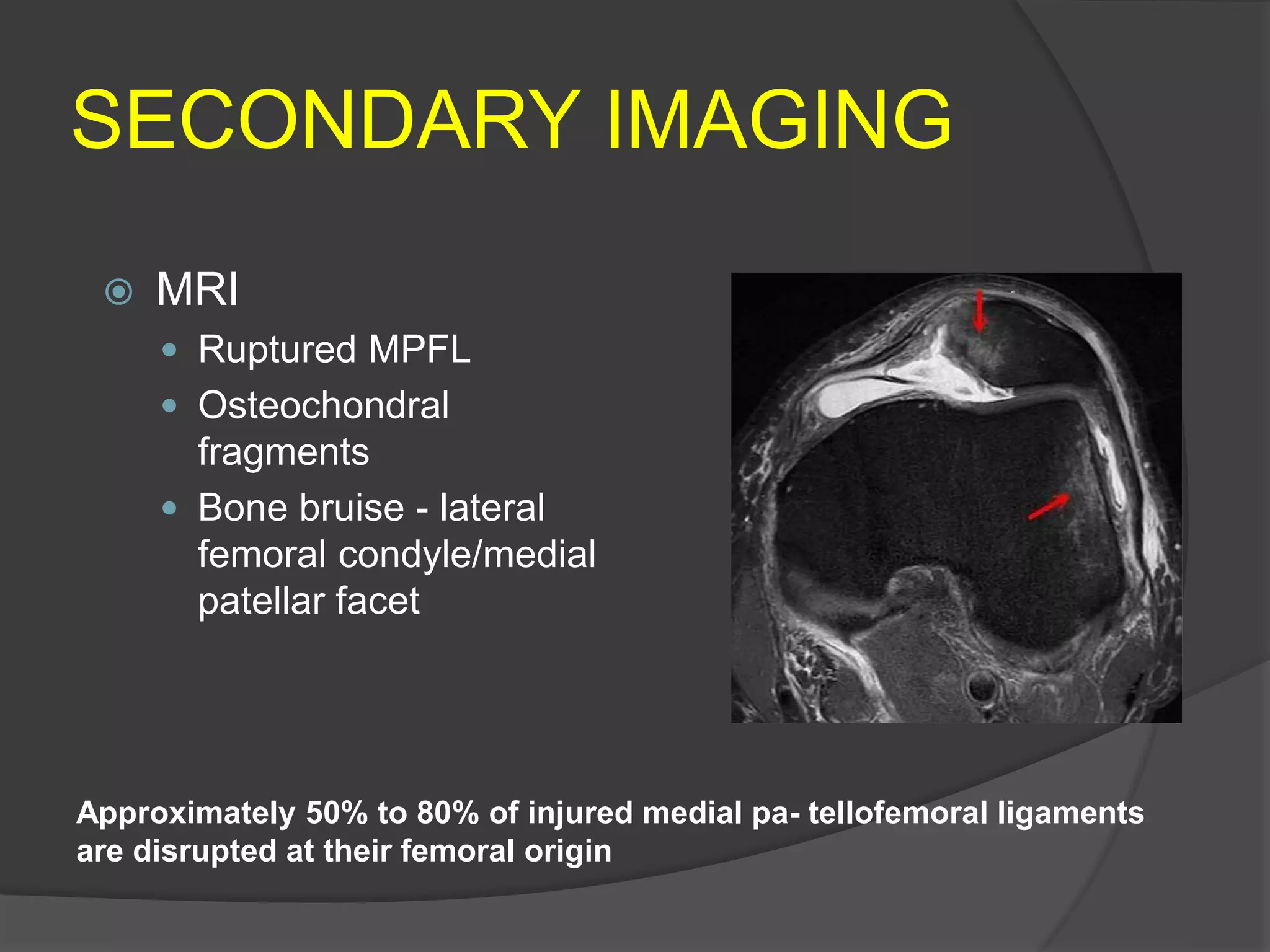  MRI
 Ruptured MPFL
 Osteochondral
fragments
 Bone bruise - lateral
femoral condyle/medial
patellar facet
SECONDARY IMAGING
Approximately 50% to 80% of injured medial pa- tellofemoral ligaments
are disrupted at their femoral origin
 