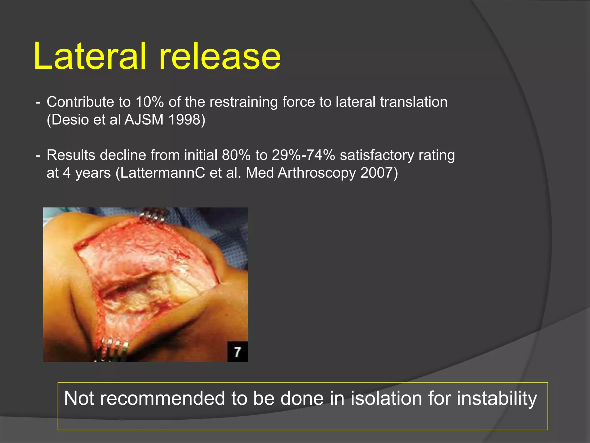 Lateral release
Not recommended to be done in isolation for instability
- Contribute to 10% of the restraining force to lateral translation
(Desio et al AJSM 1998)
- Results decline from initial 80% to 29%-74% satisfactory rating
at 4 years (LattermannC et al. Med Arthroscopy 2007)
 