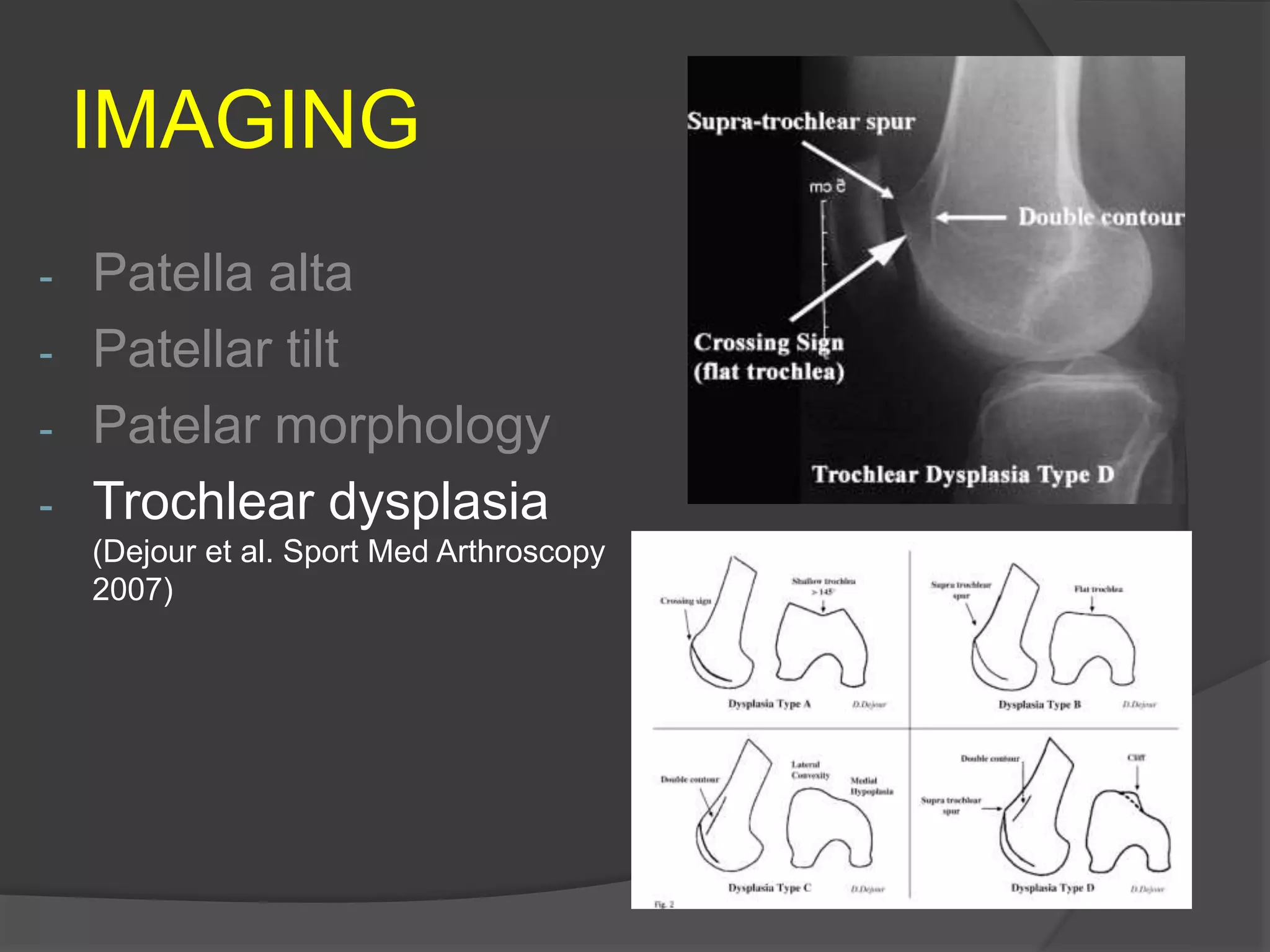 IMAGING
- Patella alta
- Patellar tilt
- Patelar morphology
- Trochlear dysplasia
(Dejour et al. Sport Med Arthroscopy
2007)
 