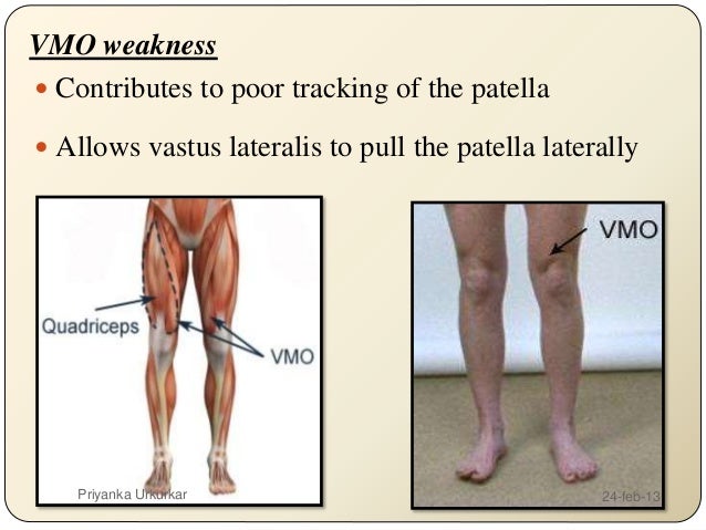patellofemoral pain syndrome pfps patella femoral syndrome