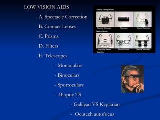   LOW VISION AIDS A. Spectacle Correction B. Contact Lenses C. Prisms  D. Filters E. Telescopes  - Monoculars  - Binoculars - Sportoculars -  Bioptic TS  - Galilean VS Keplarian    -  Ocutech autofocus 