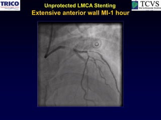 Unprotected LMCA Stenting
Extensive anterior wall MI-1 hour
 