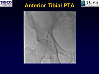 Anterior Tibial PTA
 