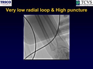 Very low radial loop & High puncture
 
