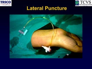 Lateral Puncture
 