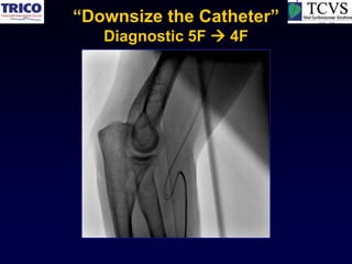 “Downsize the Catheter”
   Diagnostic 5F  4F
 