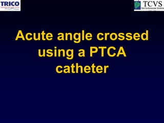Acute angle crossed
   using a PTCA
      catheter
 