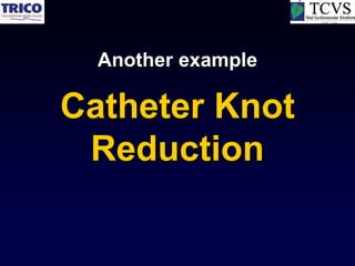 Another example

Catheter Knot
 Reduction
 