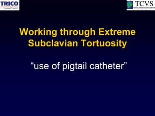 Working through Extreme
 Subclavian Tortuosity

  “use of pigtail catheter”
 
