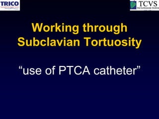 Working through
Subclavian Tortuosity

“use of PTCA catheter”
 