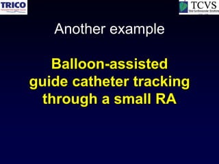Another example

   Balloon-assisted
guide catheter tracking
 through a small RA
 
