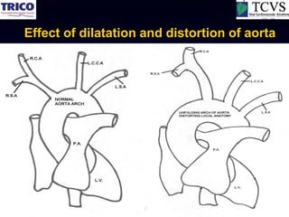 Effect of dilatation and distortion of aorta
 
