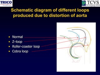 Schematic diagram of different loops
     produced due to distortion of aorta



•   Normal
•   Z–loop
•   Roller-coaster loop
•   Cobra loop
 