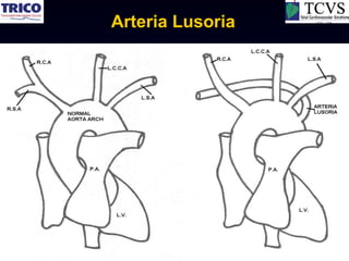 Arteria Lusoria
 
