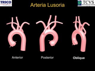 Arteria Lusoria




Anterior       Posterior     Oblique
 
