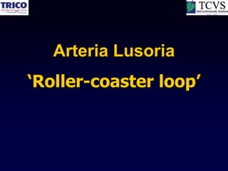 Arteria Lusoria
‘Roller-coaster loop’
 