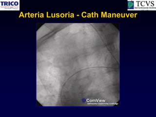 Arteria Lusoria - Cath Maneuver
 
