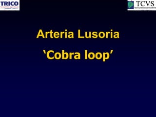 Arteria Lusoria
 ‘Cobra loop’
 